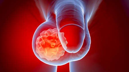 Statistic image showing 82 percent of men worried about prostate health complications